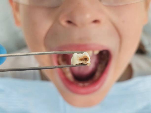 Best Broken or Cracked Tooth Emergency Dentist in Kalaheo, HI